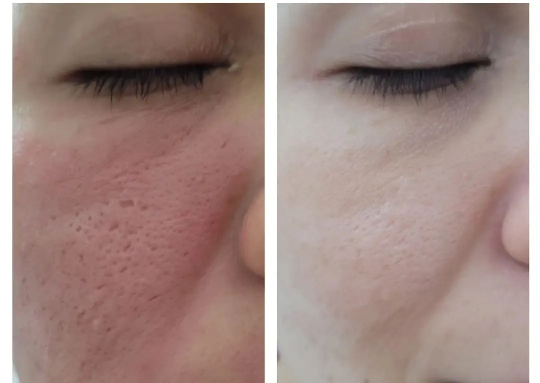 Antes e Depois do Tratamento de Cicatrizes de Acne